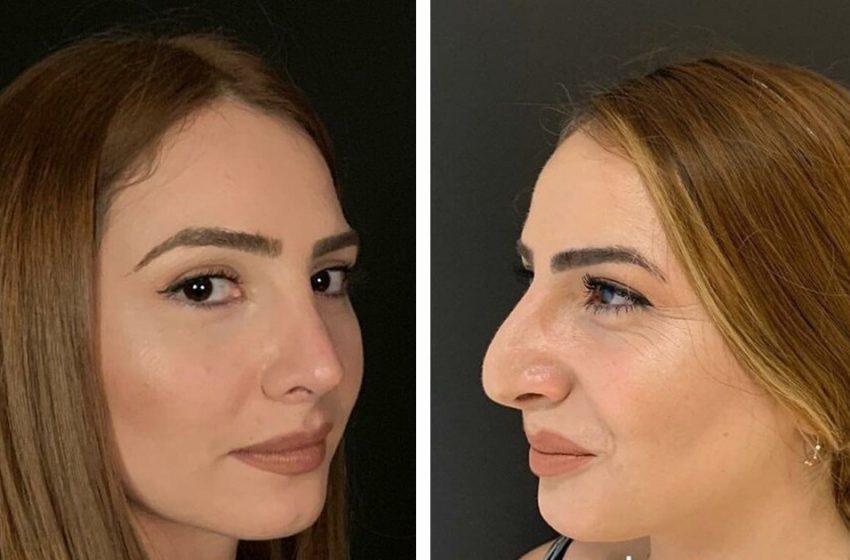  Before and after rhinoplasty: How rhinoplasty changes girls’ appearance!