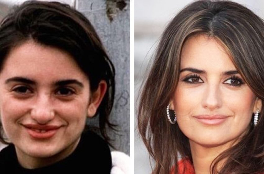  10 celebrities who have become much more attractive after changing their nose