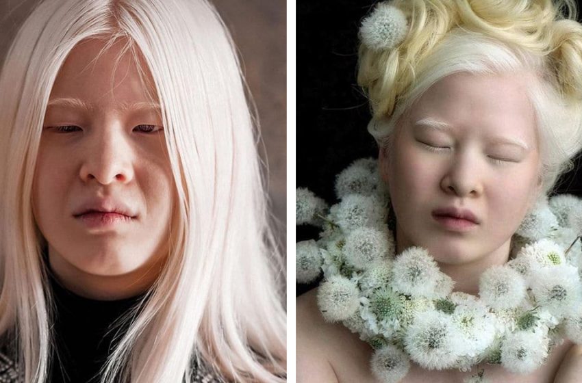  A story of a model with albinism who was put on the threshold of an orphanage as a baby!