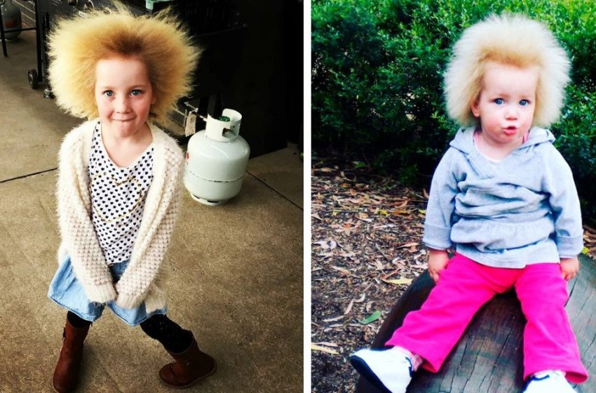  “Unruly Hair Syndrome” – look what an Australian with this syndrome looks like!