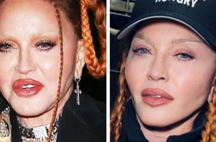  “Not Puffy Anymore, I’m Attractive!” Madonna Showed Her Face After Plastic Surgery