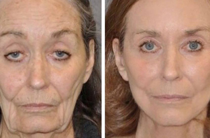  “Not so old anymore!” Women of retirement age before and after plastic surgery