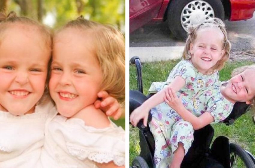 These Siamese Twins Were Separated When They Were Four Years Old And Now They Are 18 Years Old