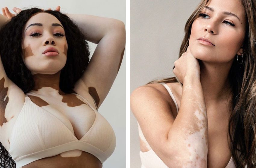  Vitiligo – Not As a Disease But As a Non-Standard Art Form: How Girls With This “Feature” Become Successful Models!