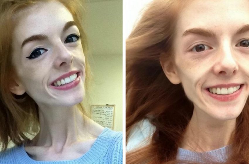  Two years ago she weighed only 64 lbs, but an ordinary chocolate bar helped her cure anorexia