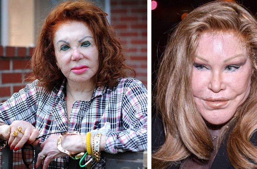  “Please, Give Them A Mirror”: The Star Beauties Who Disfigured Their Faces With Plastic Surgery!