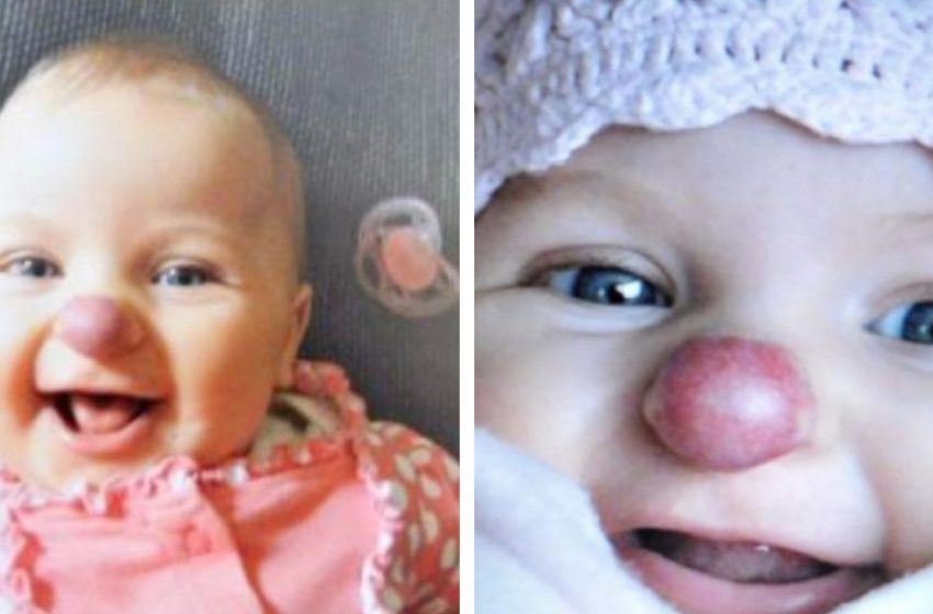  А Girl Born With a “Clown Nose”: What Does She Look Like Now?