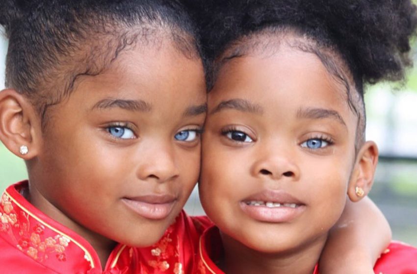  “12 Years Later”: What Do Twins With Different Eye Colors Look Like Now!